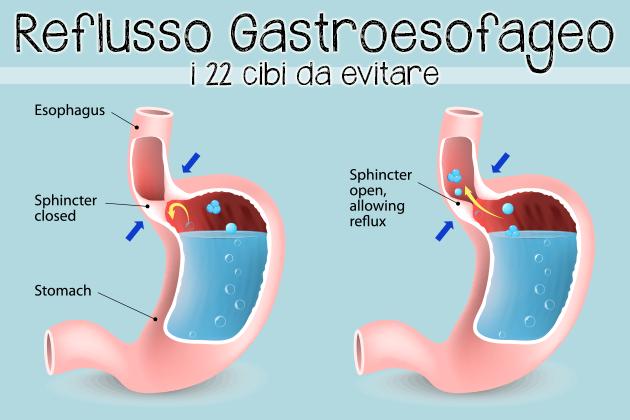 Combattere il Reflusso Gastroesofageo?